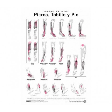 Lamination des points de déclenchement - jambe, cheville et pied