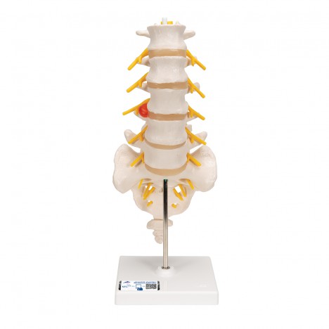 Colonne lombaire avec hernie discale dorsolatérale - 3B Smart Anatomy