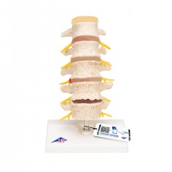 Stades du prolapsus du cartilage interventral et de la dégénérescence vertébrale - 3B Smart Anatomy