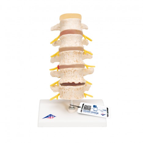 Estadios del prolapso del cartílago interventeral y de la degeneración vertebral - 3B Smart Anatomy