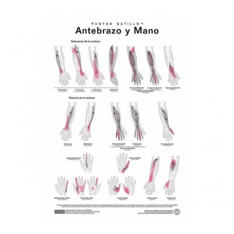 Lamination des points de déclenchement - Avant-bras et main