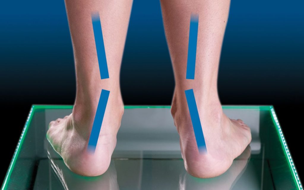 Ejemplo de pie pronador, donde el peso se focaliza en la parte interior del pie
